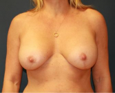 Feel Beautiful - Breast Implants Lift Natural - After Photo